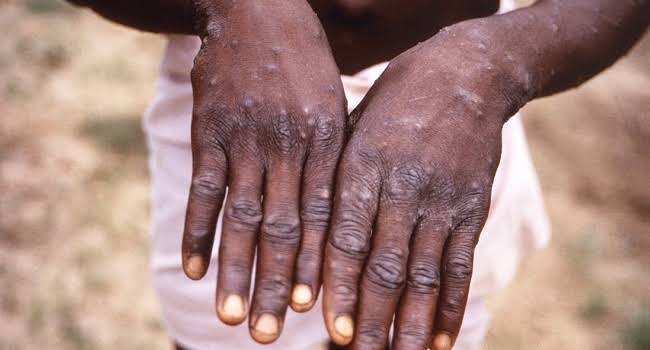 NCDC Announces More Cases Of Monkeypox In Nigeria